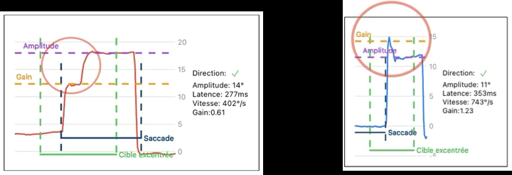 Exemples de saccade hypométrique (gauche) et hypermétrique (droite).